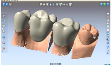 DentCAD設計的假牙模型 DentCAD設計的假牙模型